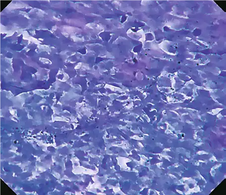 Tumor (esophagus) Tumor (esophagus)