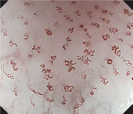 Tumor (esophagus) Tumor (esophagus)