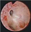 Conventional fiberscope image