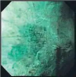 NBI 图像 NBI 图像