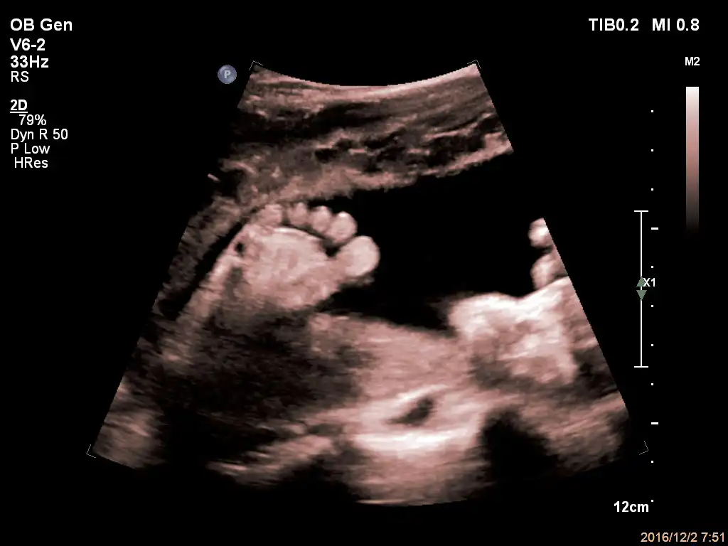 V6-2探头显示胎儿足部