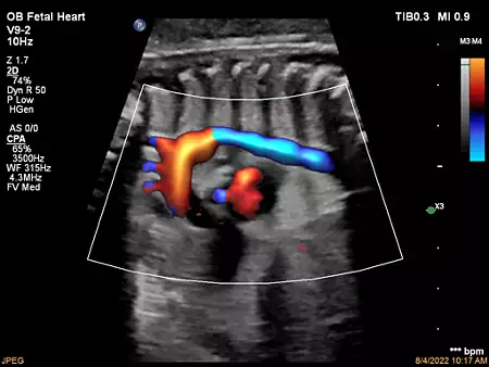 V9-2 Aortic Arch with FlowViewer