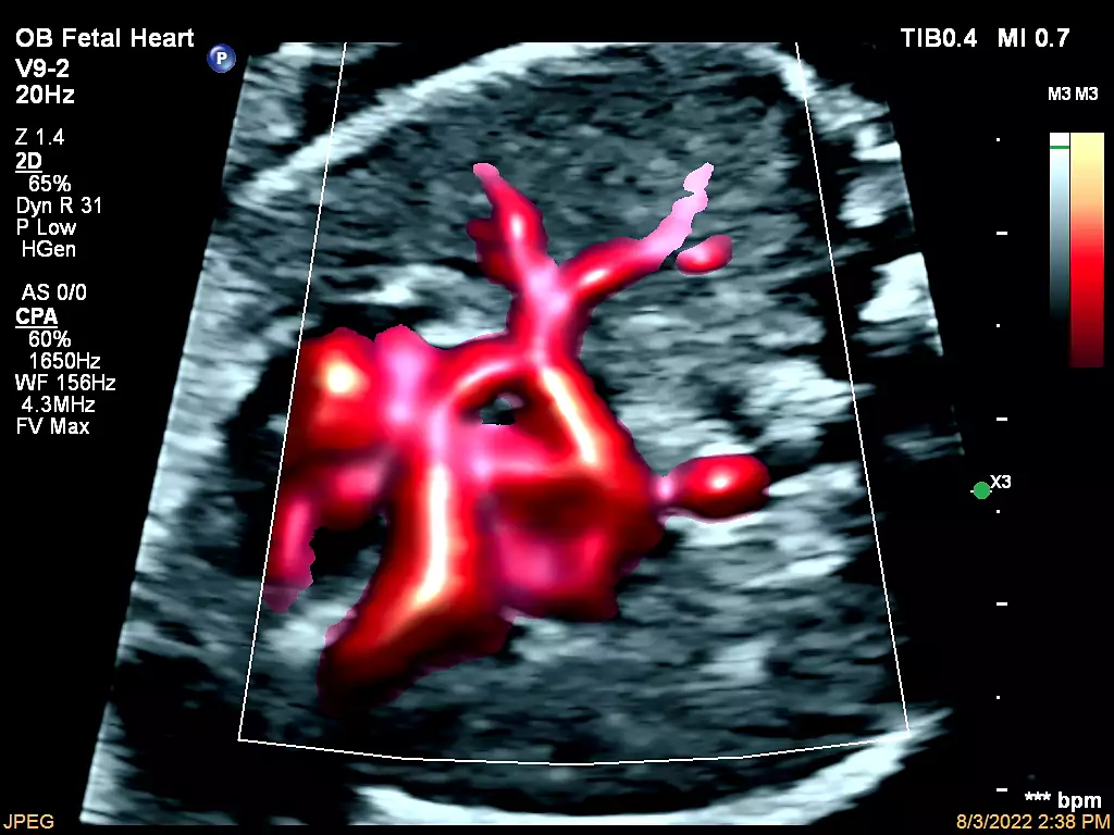 V9-2 Fetal Heart CPA with Flow Viewer