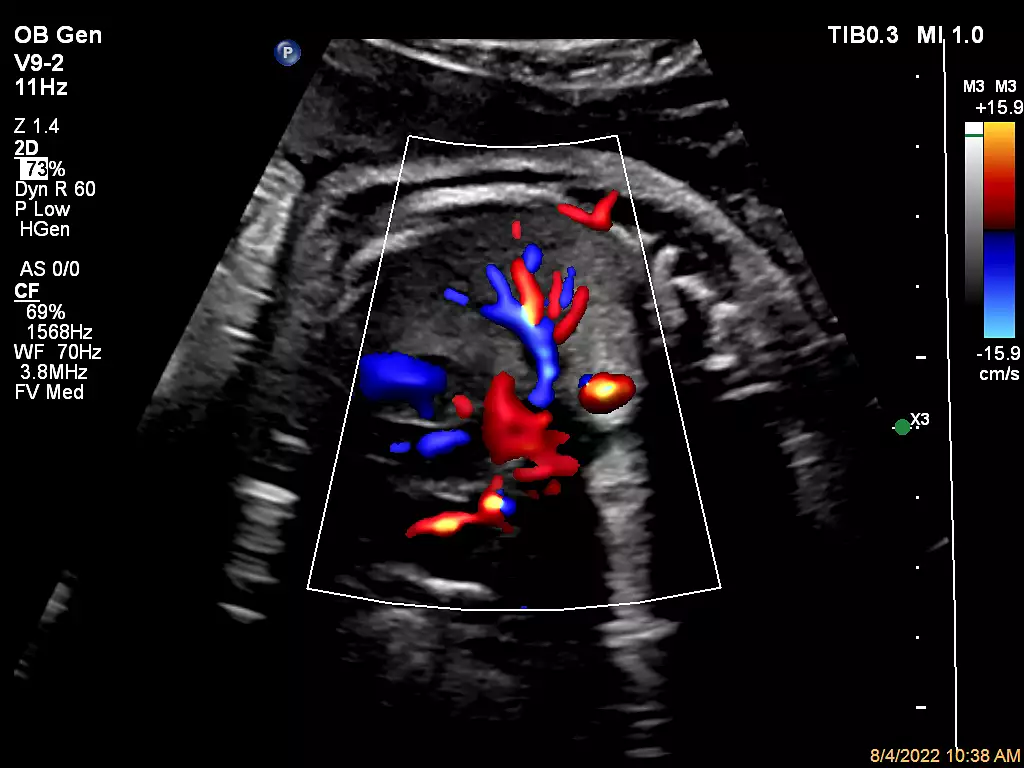 V9-2 Fetal Lung Perfusion with Flow Viewer