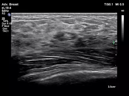 eL18-4 Adv Breast
