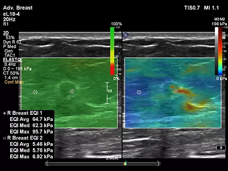 eL18-4 Linear ElastQ Breast