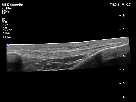 eL18-4 Adv Breast
