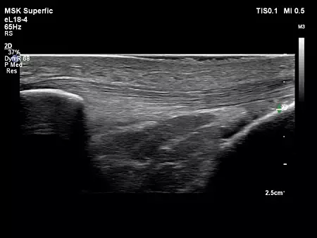 eL18-4 MSK Patellar Tendon