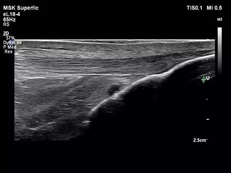 eL18-4 MSK Shoulder