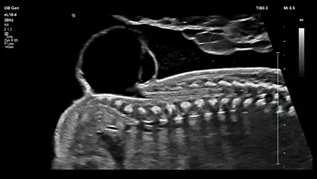 eL18-4 OB Fetal Spine