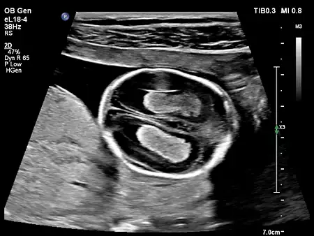 eL18-4 OB Imaging