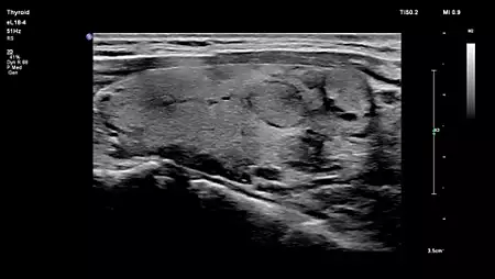 eL18-4 Thyroid