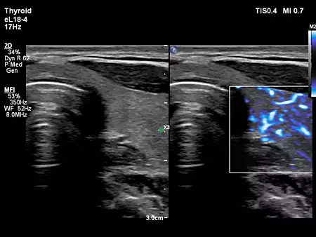 eL18-4 Testicular Imaging with MicroFlow Imaging