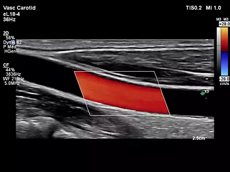 eL18-4 Vascular Carotid