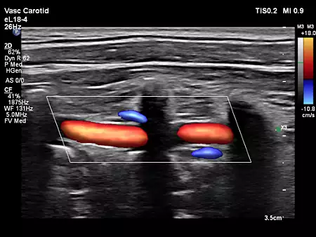 eL18-4 Vertebral Perfusion with Flow Viewer