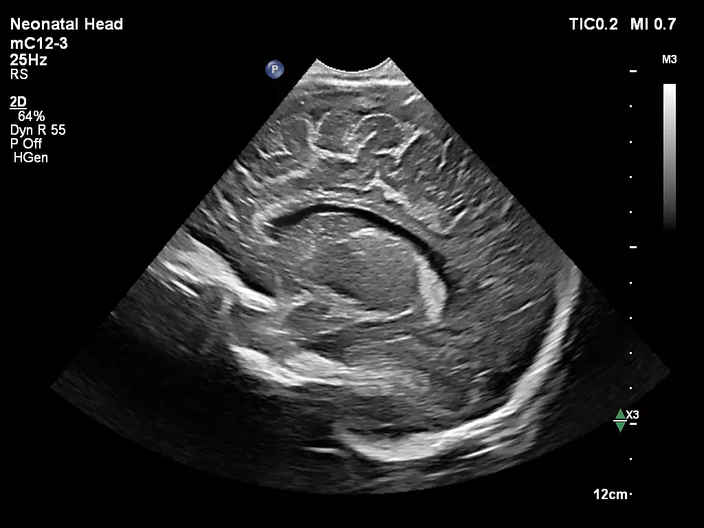 mC12-3 Neonatal Head