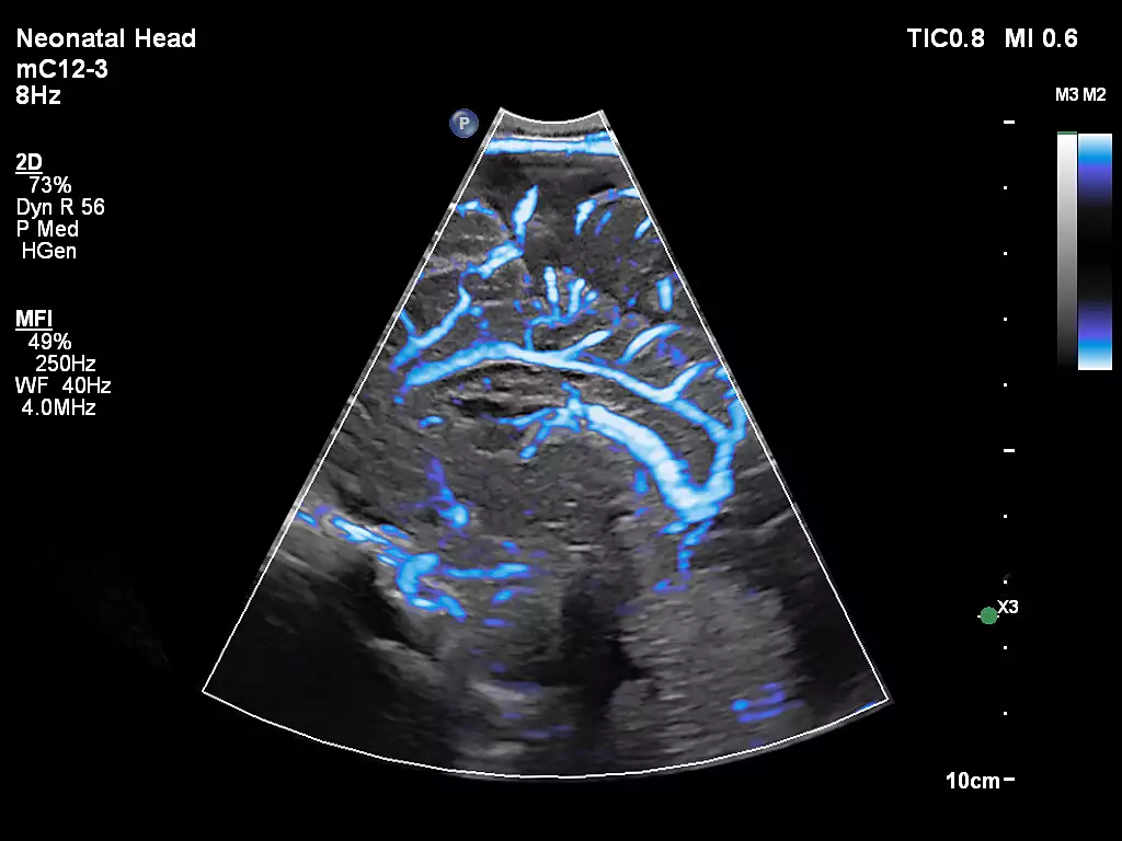 mC12-3 Neonatal Head MFI