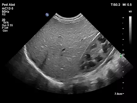 mC12-3 Pediatric Liver Kidney