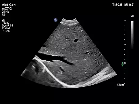 mC7-2 Abdominal Liver
