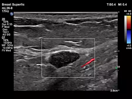 mL26-8 Breast