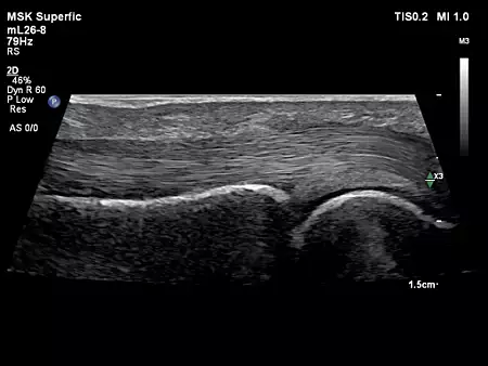 mL26-8 MSK Flexor Tendon