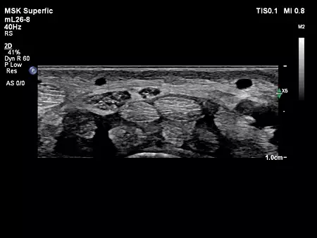 mL26-8 MSK Wrist
