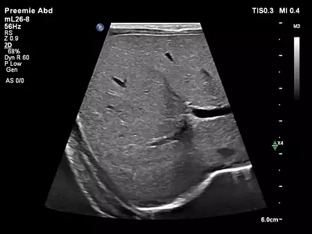 mL26-8 Pediatric Liver