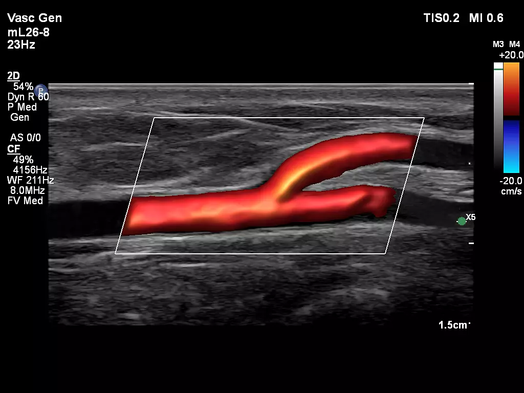 mL26-8 Superficial Artery with FlowViewer
