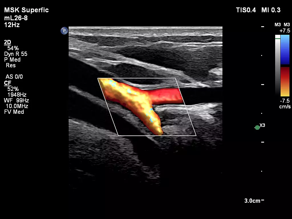 mL26-8 Upper Extremity Arterial