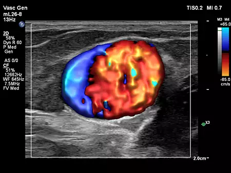 mL26-8 Vascular Fistula with Flow Viewer